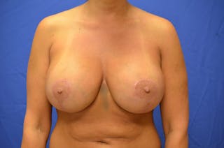 Breast Augmentation + Lift Before & After Gallery - Patient 350777 - Image 2