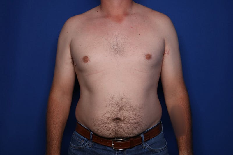 Gynecomastia (Male Breast Reduction) Before & After Gallery - Patient 197171 - Image 1