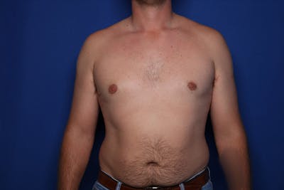 Gynecomastia (Male Breast Reduction) Before & After Gallery - Patient 197171 - Image 2