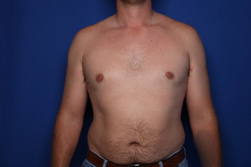 Gynecomastia (Male Breast Reduction) Before & After Gallery - Patient 197171 - Image 2