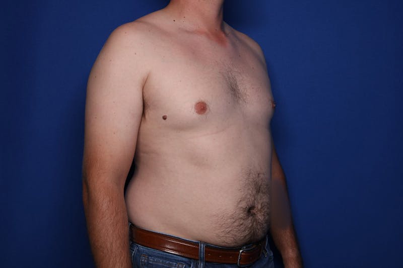 Gynecomastia (Male Breast Reduction) Before & After Gallery - Patient 197171 - Image 3