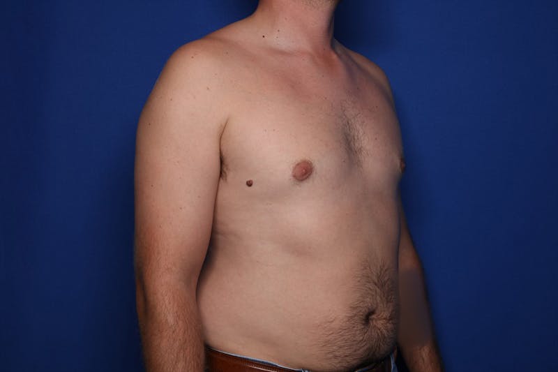 Gynecomastia (Male Breast Reduction) Before & After Gallery - Patient 197171 - Image 4