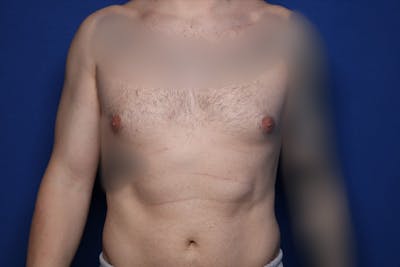 Gynecomastia (Male Breast Reduction) Before & After Gallery - Patient 860284 - Image 1