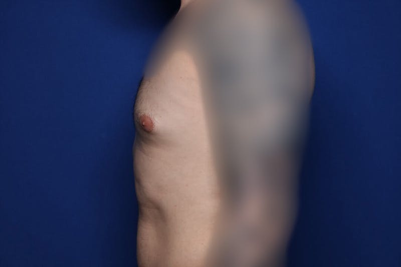 Gynecomastia (Male Breast Reduction) Before & After Gallery - Patient 860284 - Image 3