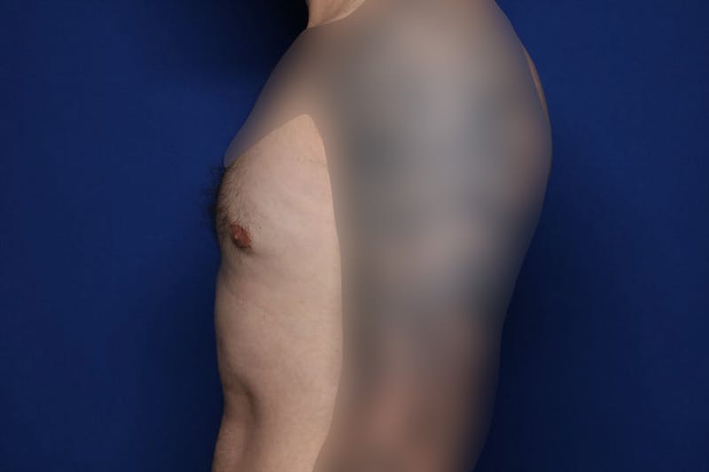 Gynecomastia (Male Breast Reduction) Before & After Gallery - Patient 860284 - Image 4
