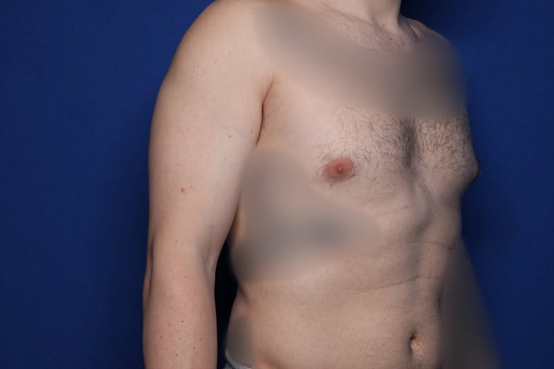 Gynecomastia (Male Breast Reduction) Before & After Gallery - Patient 860284 - Image 5