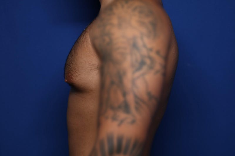 Gynecomastia (Male Breast Reduction) Before & After Gallery - Patient 378481 - Image 5