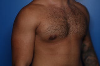 Gynecomastia (Male Breast Reduction) Before & After Gallery - Patient 378481 - Image 4