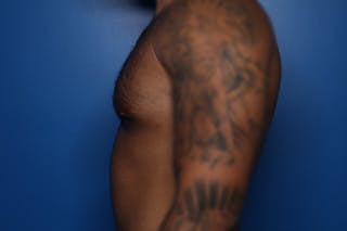 Gynecomastia (Male Breast Reduction) Before & After Gallery - Patient 378481 - Image 6
