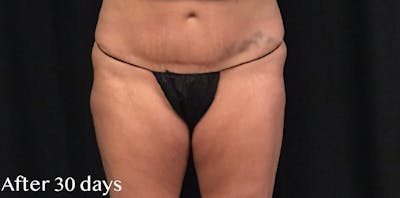 CoolSculpting® Before & After Gallery - Patient 186372 - Image 2