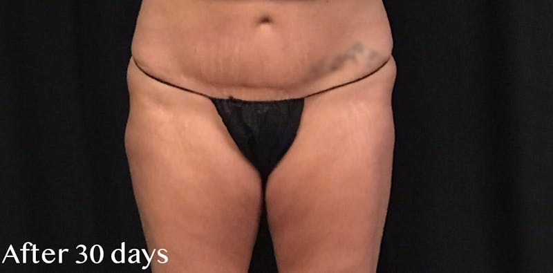 CoolSculpting® Before & After Gallery - Patient 186372 - Image 2