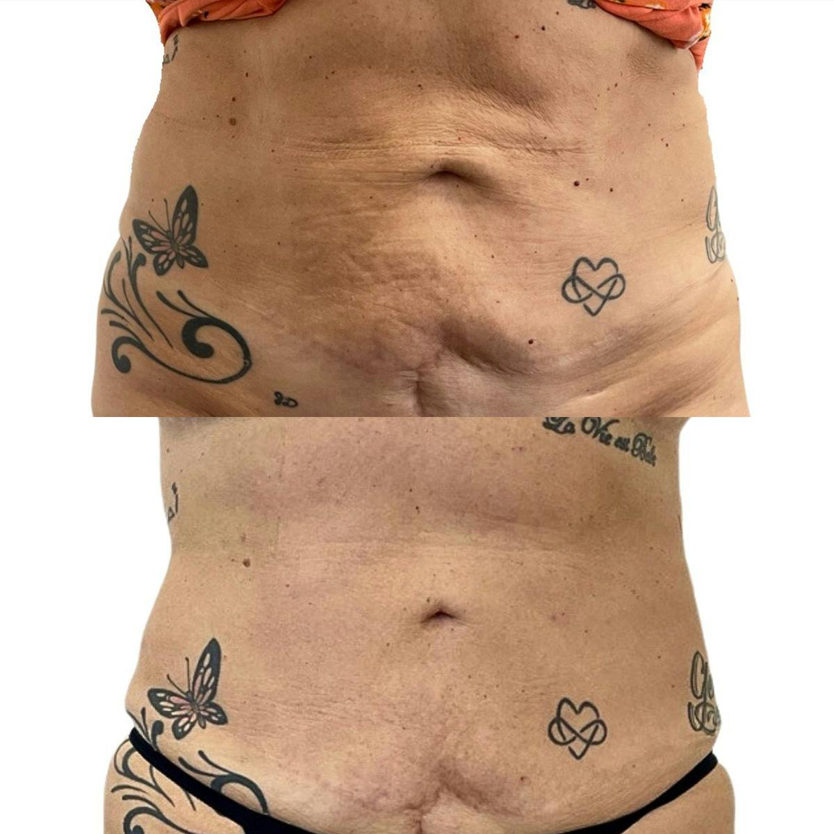 Morpheus8® Before & After Gallery - Patient 316440 - Image 1