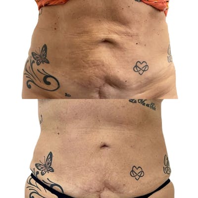 Morpheus8® Before & After Gallery - Patient 316440 - Image 1