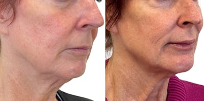 Juvéderm® Before & After Gallery - Patient 415916 - Image 1