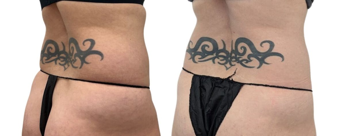 CoolSculpting® Before & After Gallery - Patient 426433 - Image 2