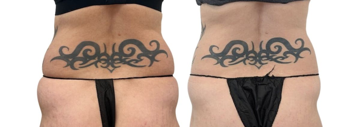 CoolSculpting® Before & After Gallery - Patient 426433 - Image 1