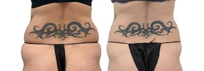 CoolSculpting® Before & After Gallery - Patient 426433 - Image 1
