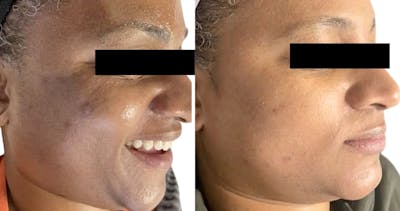 SkinPen® Microneedling Before & After Gallery - Patient 918939 - Image 1