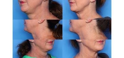 FaceTite Before and After Before & After Gallery - Patient 471160 - Image 1