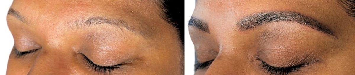 Eyebrow Microblading Before & After Gallery - Patient 161106 - Image 1