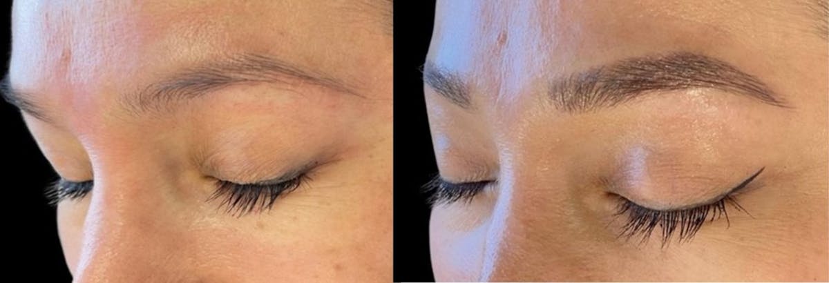 Eyebrow Microblading Before & After Gallery - Patient 353962 - Image 1