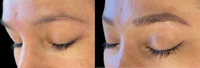 Eyebrow Microblading Before & After Gallery - Patient 353962 - Image 1