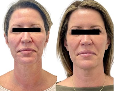 Sciton® Halo Before & After Gallery - Patient 117330 - Image 1