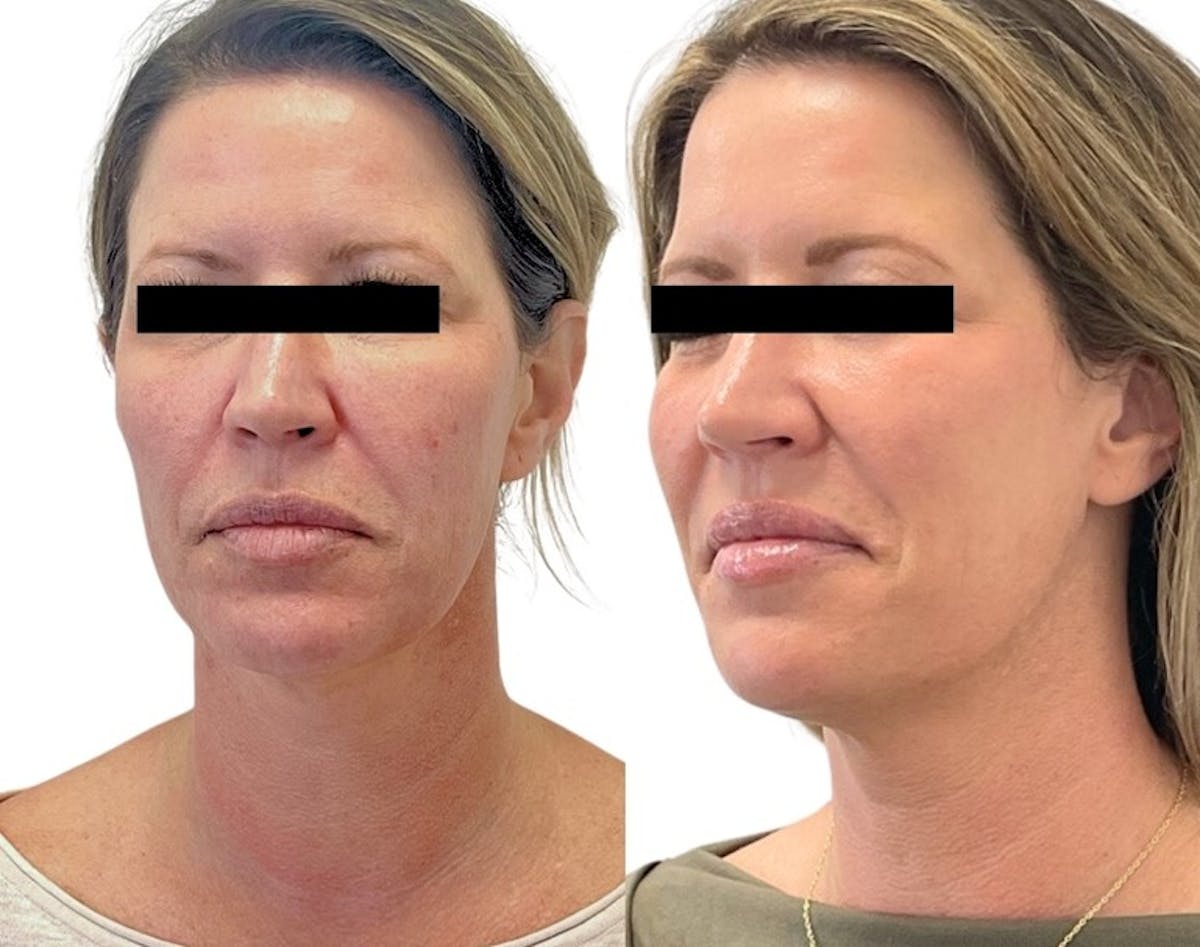 Sciton® Halo Before & After Gallery - Patient 117330 - Image 2