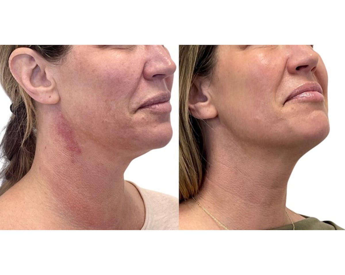 Sciton® Halo Before & After Gallery - Patient 117330 - Image 3