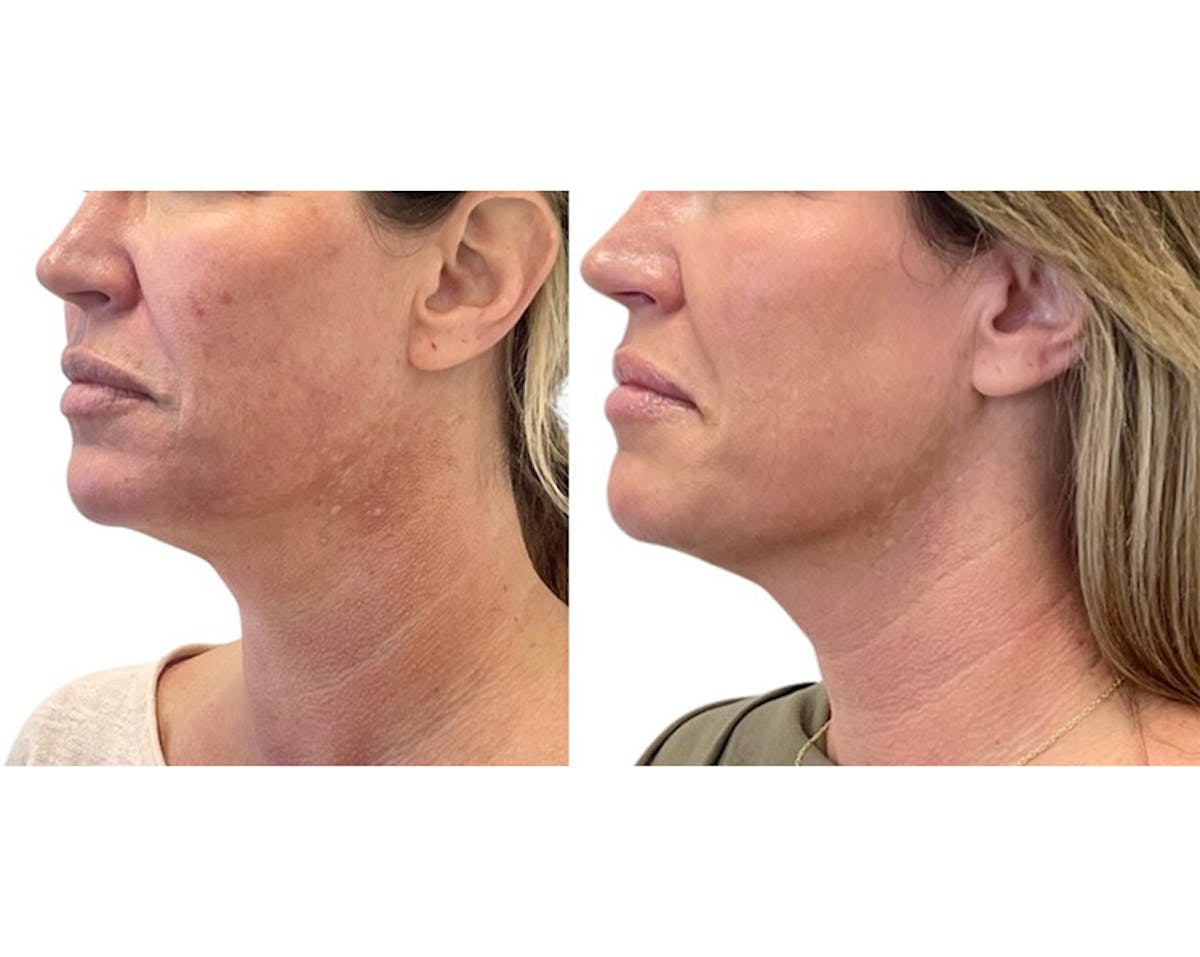 Sciton® Halo Before & After Gallery - Patient 117330 - Image 4