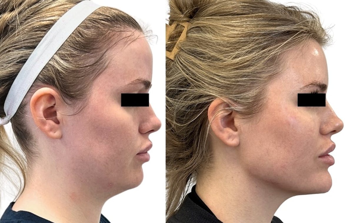 Morpheus8® Before & After Gallery - Patient 247864 - Image 2