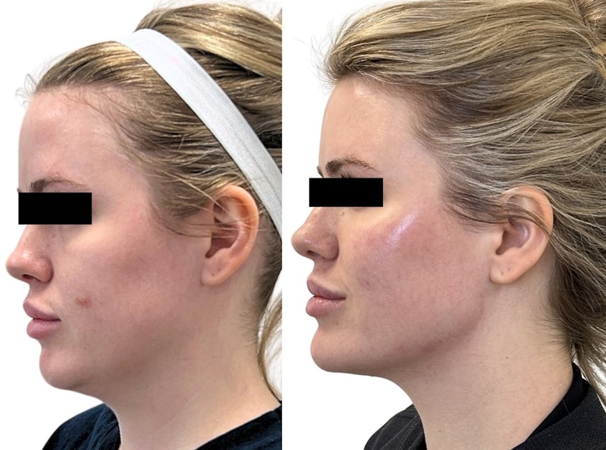 Morpheus8® Before & After Gallery - Patient 247864 - Image 1