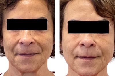 SkinPen® Microneedling Before & After Gallery - Patient 247022 - Image 1