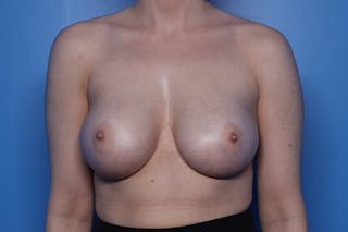 Breast Augmentation Before & After Gallery - Patient 122470 - Image 2
