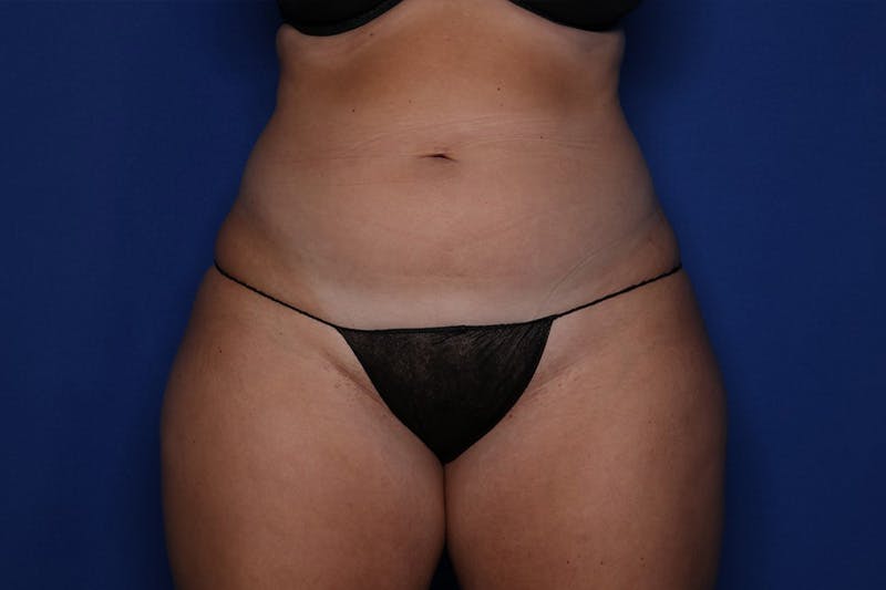 Liposuction Before & After Gallery - Patient 239230 - Image 1