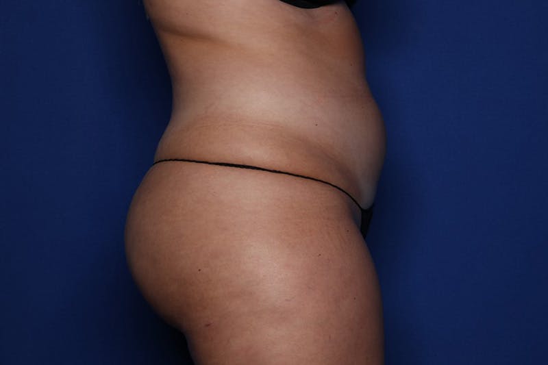 Liposuction Before & After Gallery - Patient 239230 - Image 3
