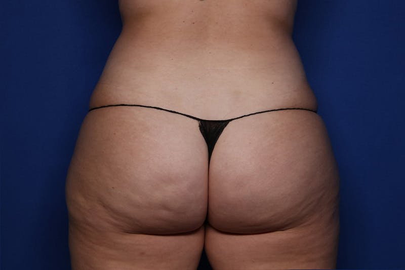 Liposuction Before & After Gallery - Patient 239230 - Image 5