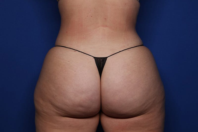 Liposuction Before & After Gallery - Patient 239230 - Image 6
