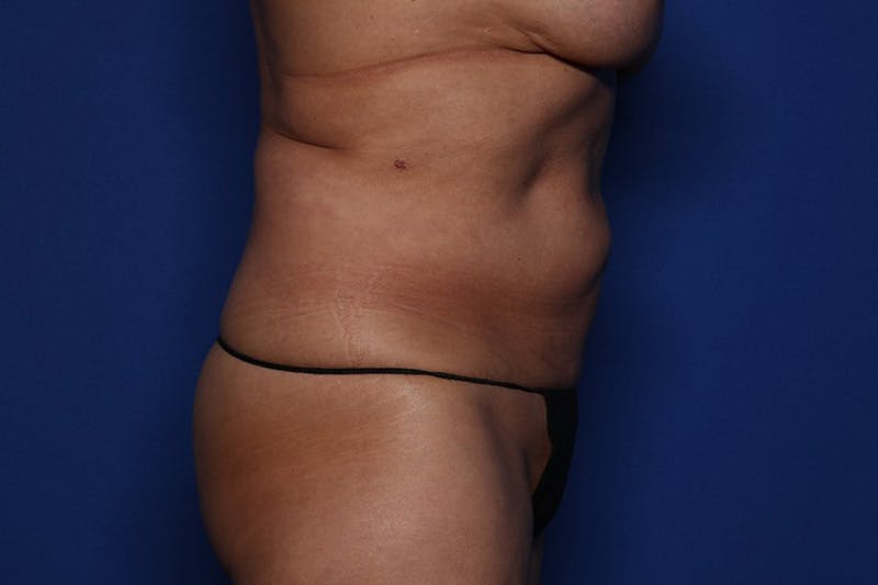 Tummy Tuck Before & After Gallery - Patient 375482 - Image 3