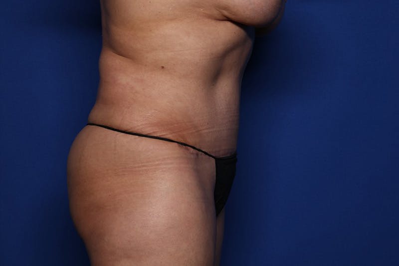 Tummy Tuck Before & After Gallery - Patient 375482 - Image 4
