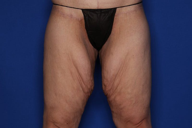 Thigh Lift Before & After Gallery - Patient 158718 - Image 1