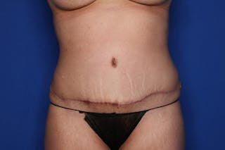 Tummy Tuck Before & After Gallery - Patient 623152 - Image 2