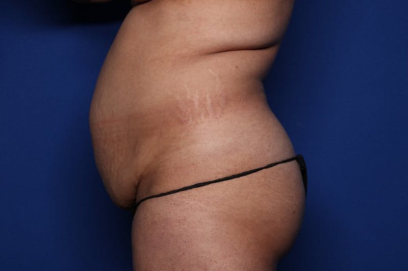 Tummy Tuck Before & After Gallery - Patient 623152 - Image 3