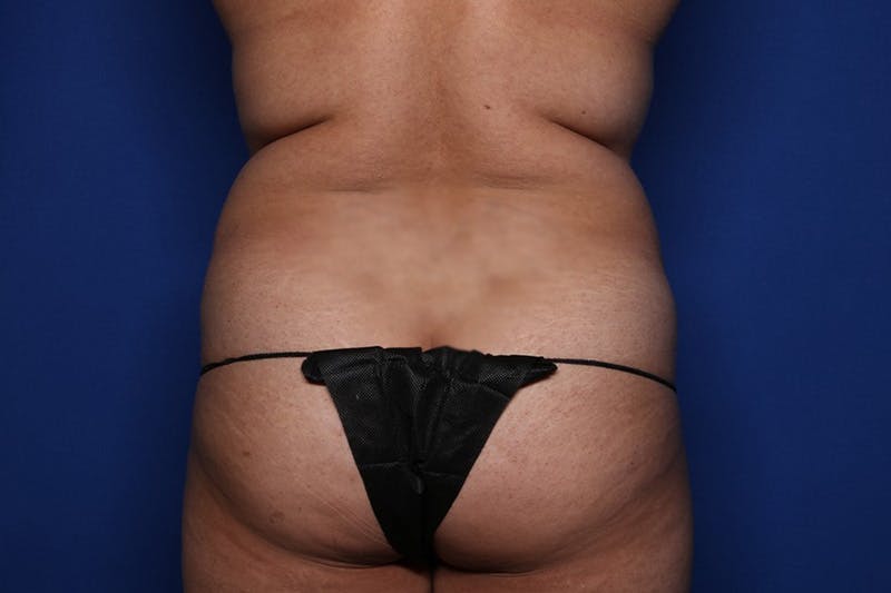 Liposuction Before & After Gallery - Patient 146107 - Image 1
