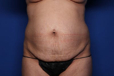 Tummy Tuck Before & After Gallery - Patient 623152 - Image 1