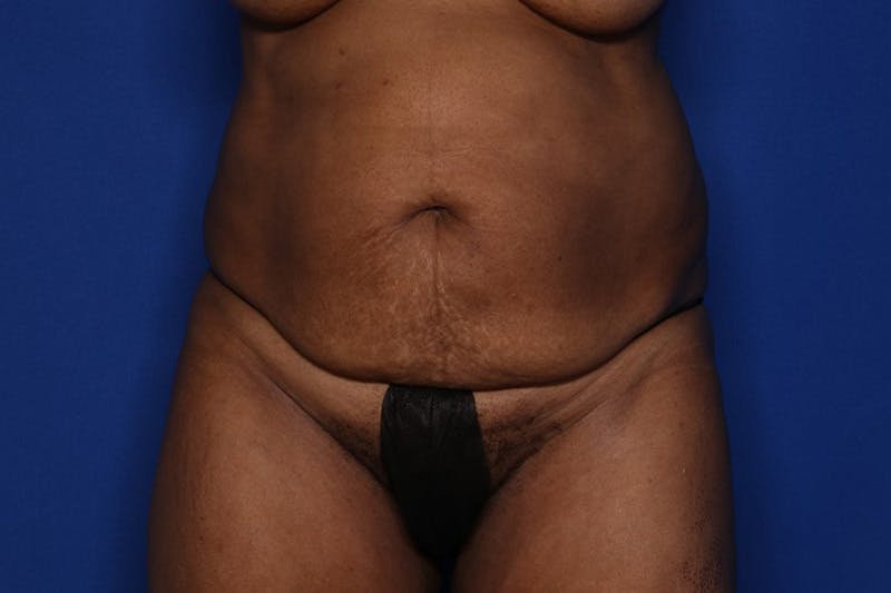 Tummy Tuck Before & After Gallery - Patient 897126 - Image 1