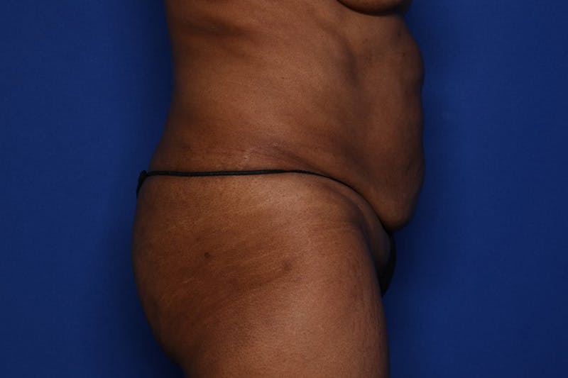 Tummy Tuck Before & After Gallery - Patient 897126 - Image 3
