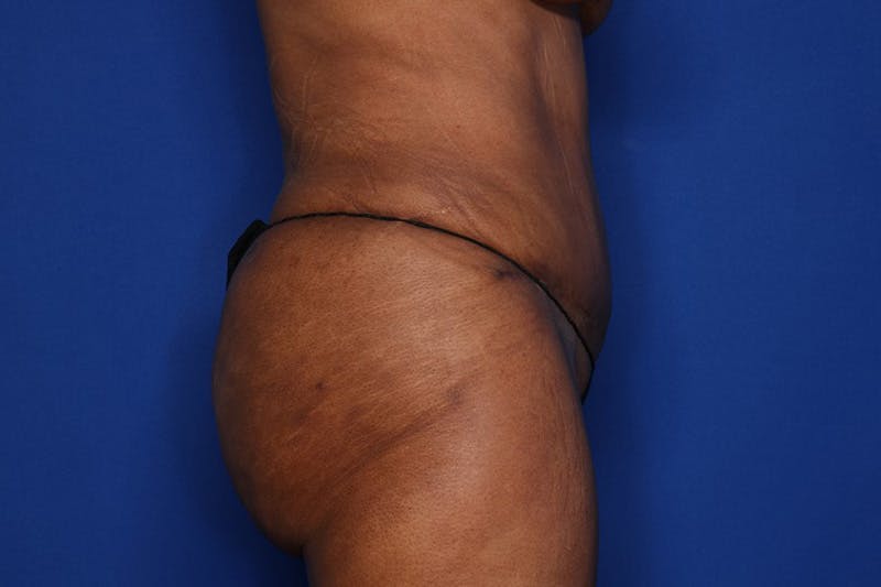 Tummy Tuck Before & After Gallery - Patient 897126 - Image 4
