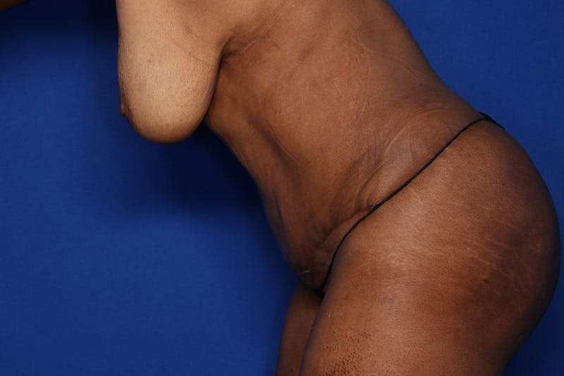 Tummy Tuck Before & After Gallery - Patient 897126 - Image 6