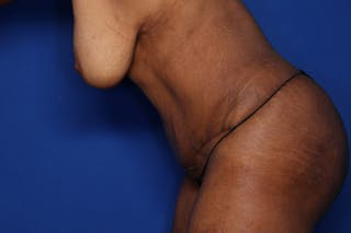 Tummy Tuck Before & After Gallery - Patient 897126 - Image 6